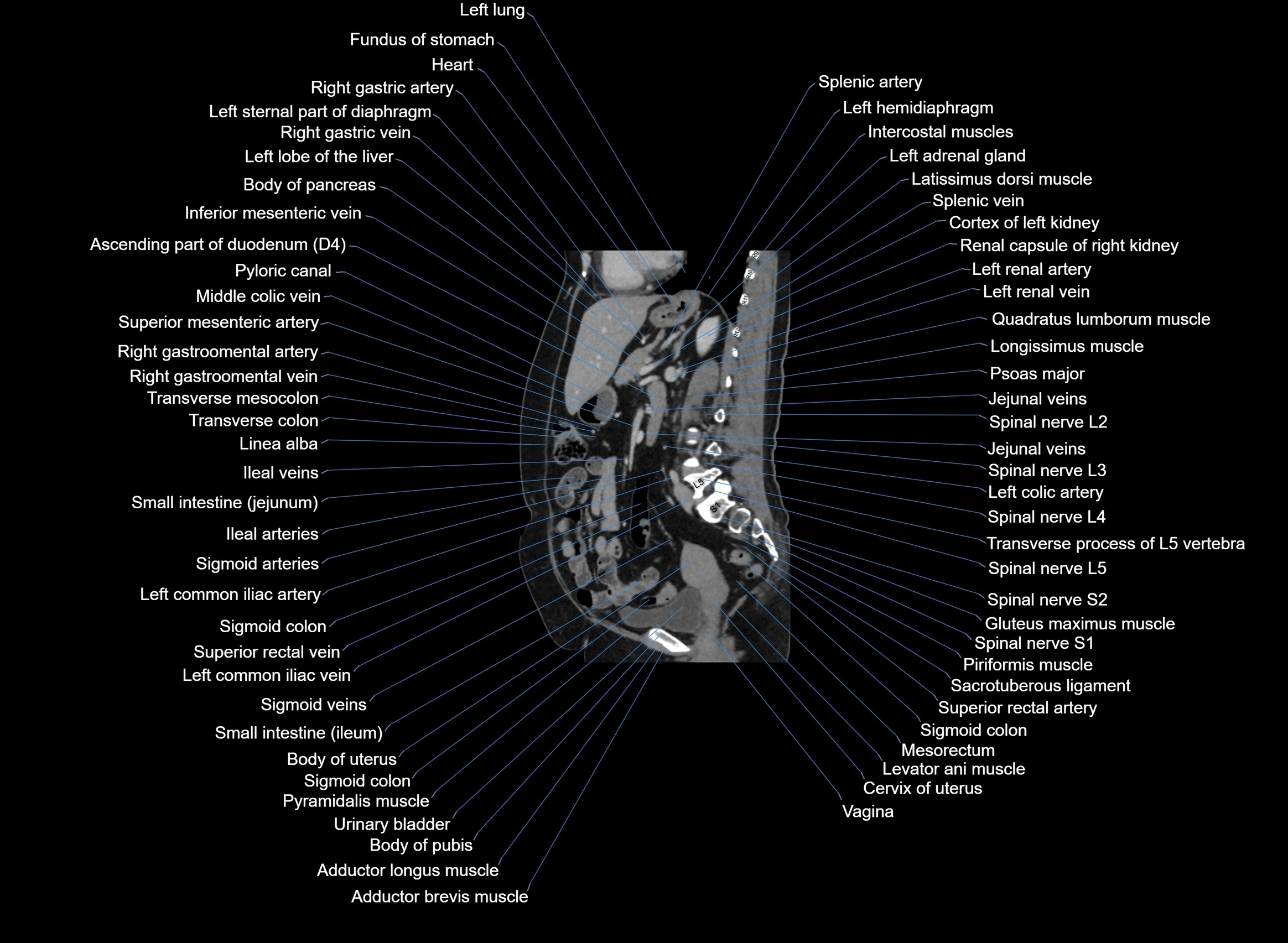 CT Abdomen sagittal cross sectional anatomy labelled radiology image -00052.webp